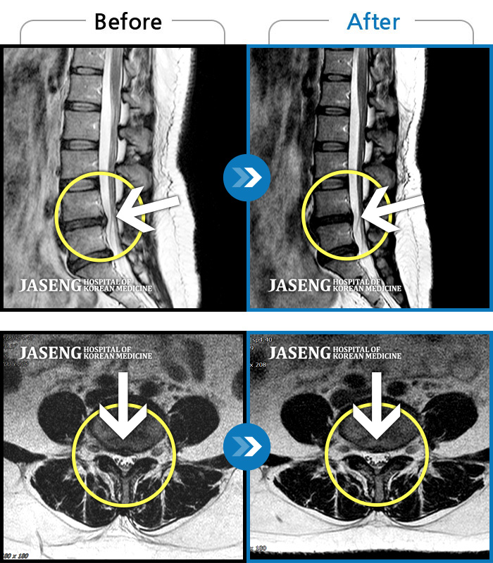 õڻѹ溴 ġ MRI  ġ- ħ ġḦ Ͽ ȣ Ǿٰ       ϰ ߻Ͽ   ũ ġḦ  ȯ Դϴ. 